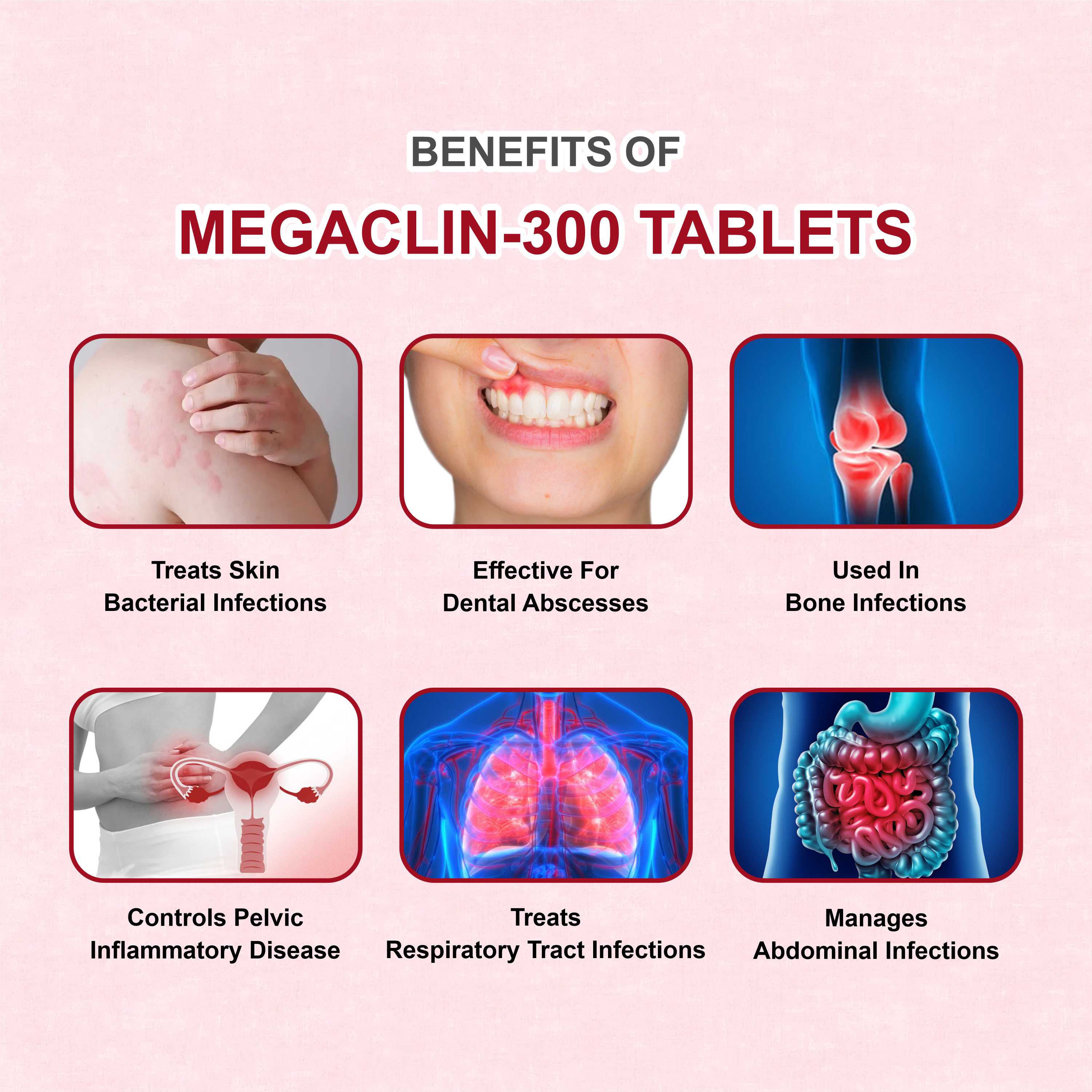 Megaclin 300 Clindamycin Capsule – Lung, Skin & Bacterial Infection Treatment